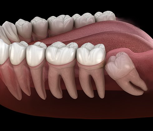 Animated smile with impacted wisdom tooth in need of extraction