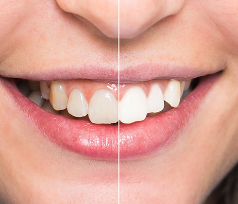 Closeup of smile before and after cosmetic dentistry