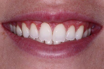 Closeup of gorgeous smile after gum recontouring
