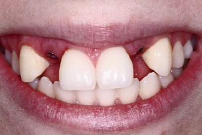 Smile with congenitally missing teeth