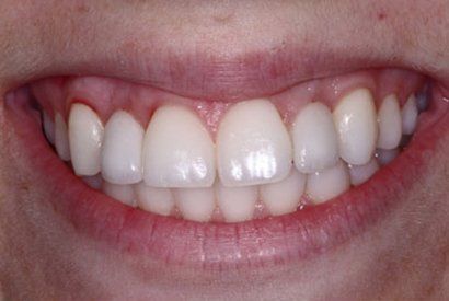 Smile after congenitally missing teeth are replaced