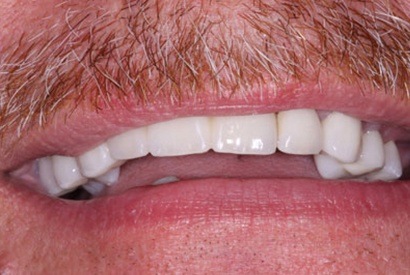 Smile with seamlessly replaced top tooth