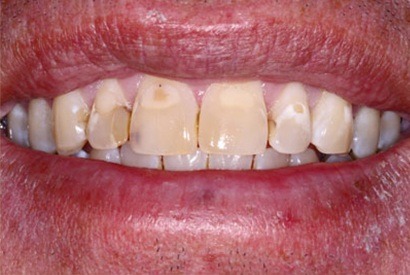 Decayed and discolred teeth before cosmetic dentistry