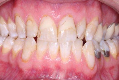 Decayed and damaged smile before dental treatment