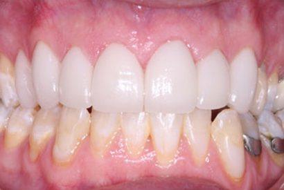 Healthy attractive smile after dental treatment