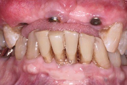 Smile with missing top teeth with dental implant posts visible
