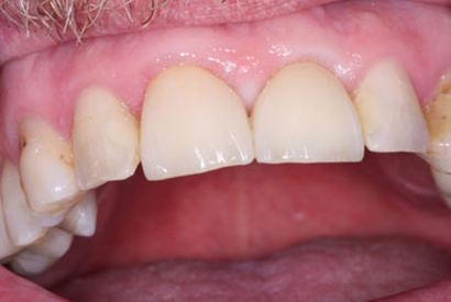 Smile with missing teeth replaced with dental implant supported restorations