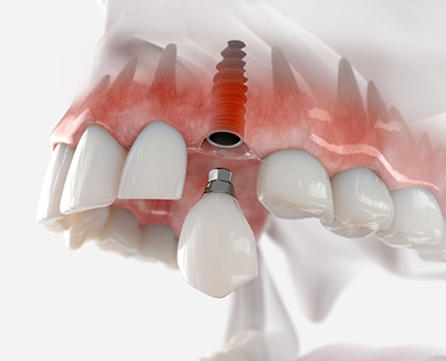 Dental crown being attached to dental implant in upper arch