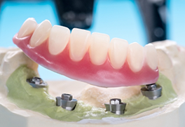 Dentures and model of mouth with dental implants