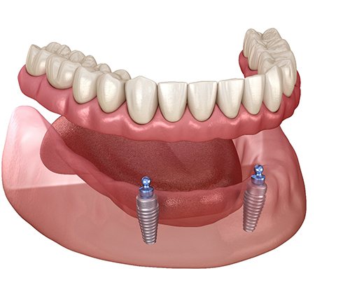 3D graphic of implant dentures 