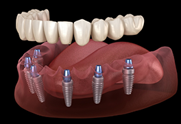 Illustration of dentures being attached to dental implants