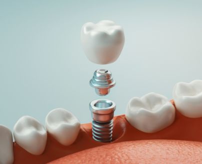 Digital diagram of how dental implants in Midlothian work