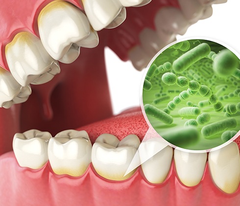 Animated smile with enlarged bacteria in need of periodontal therapy