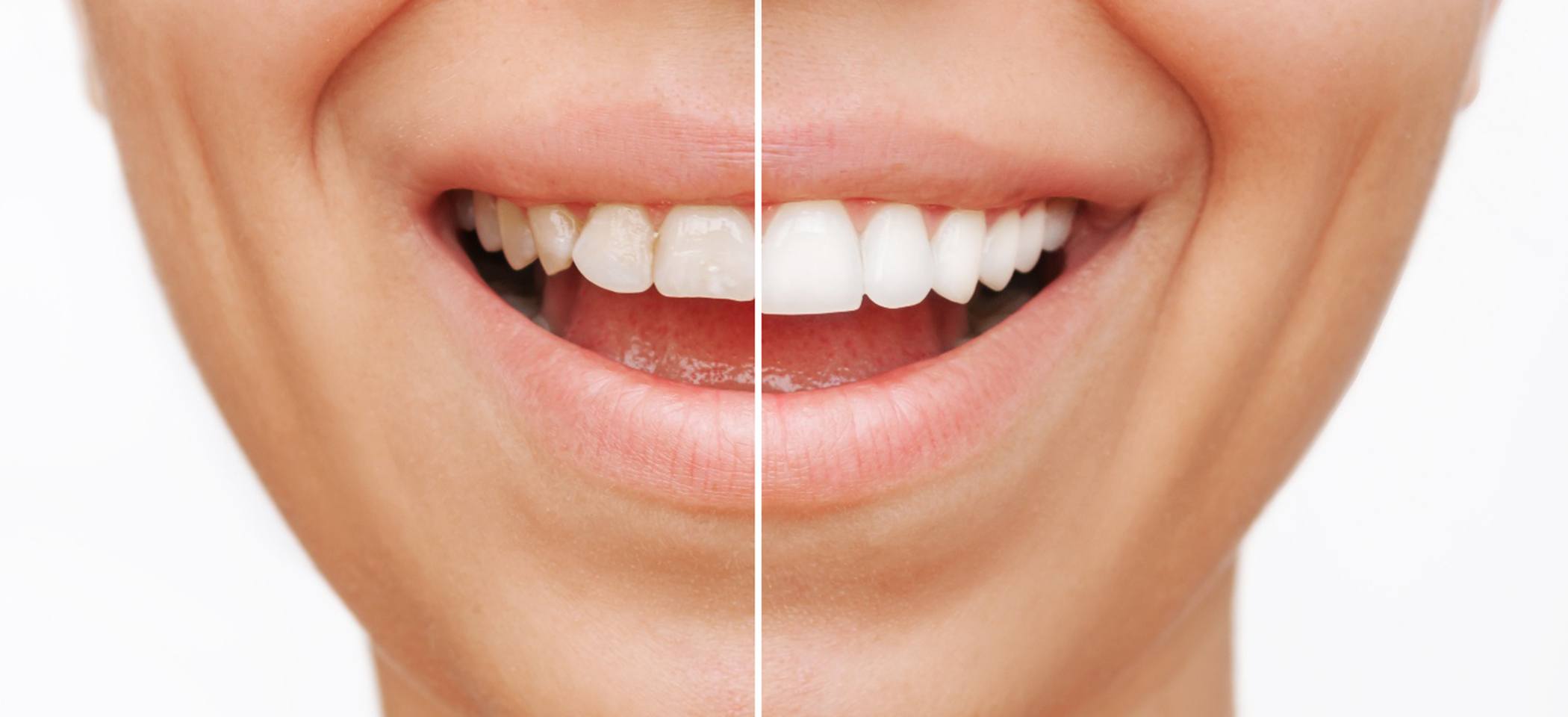 before and after split photo of a person smiling